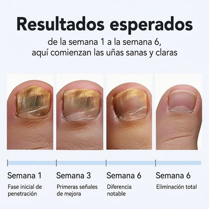 NiteCure™ Recuperación nocturna para hongos en las uñas